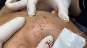 396 • Acne collection • АСМР • Relax Spa