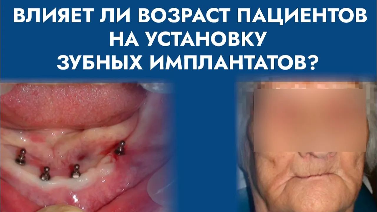 Как устанавливать зубные имплантаты у пожилых пациентов?