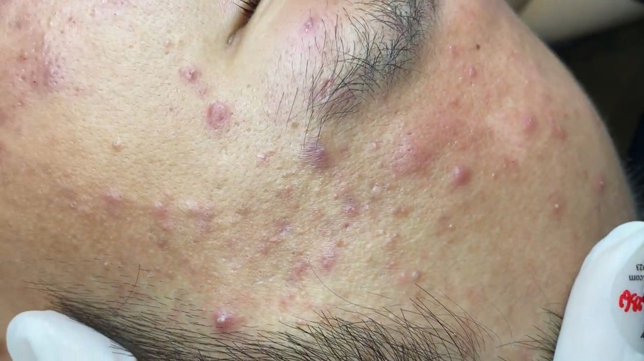 395 • Acne Collection • АСМР • Relax Spa