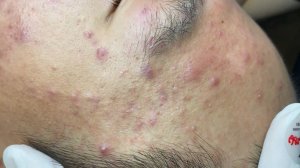 395 • Acne collection • АСМР • Relax Spa