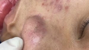 398 • Acne collection • АСМР • Relax Spa