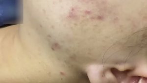 Профессиональное удаление прыщей и чёрных точек