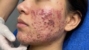 Чистка лица от черных точек в Sac Dep Spa