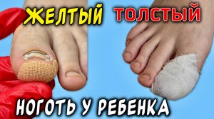 Глубоко вросший ноготь у ребенка 💔