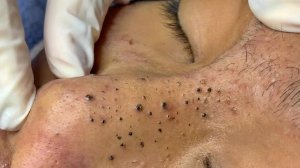 Удаление черных точек в Sac Dep Spa