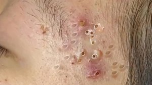 Экстремальное удаление черных точек: удовлетворение и расслабление
