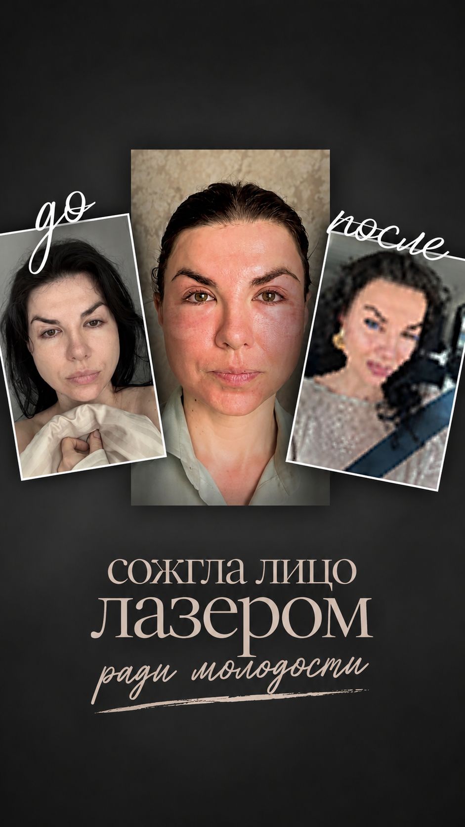 Я сожгла лицо лазером 😳 Полный выпуск у меня на канале