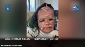«Маска Бэтмена» снята: Луна Феннер впервые увидела свое лицо после операции в Петербурге