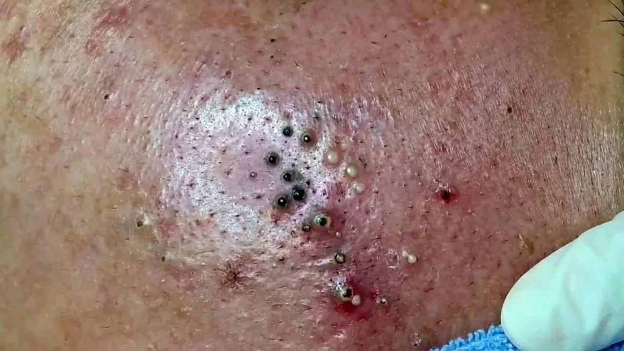 Удаление чёрных точек в Sac Dep Spa