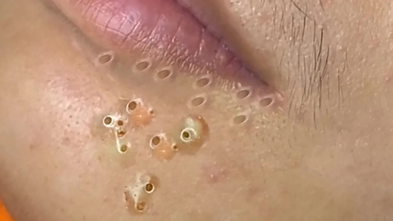 Extreme Blackhead Removal Satisfying Relaxing #1229