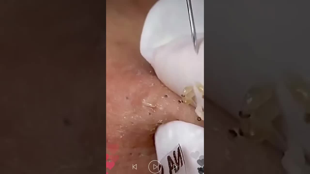 Уход за кожей | Удаление чёрных точек