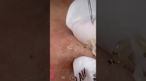 Уход за кожей | Удаление чёрных точек