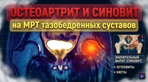Двусторонний СИНОВИТ и ОСТЕОАРТРОЗ тазобедренного сустава 1 степени на РАСШИФРОВКЕ МРТ второе мнение