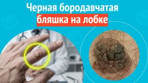 👉 Черная бородавчатая бляшка на лобке. Клинический случай № 1829