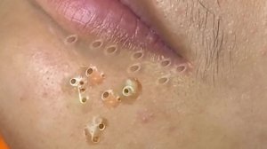 Extreme Blackhead Removal Satisfying Relaxing #1229