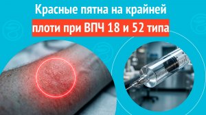 🥴 Красные пятна на крайней плоти при ВПЧ 18 и 52 типа