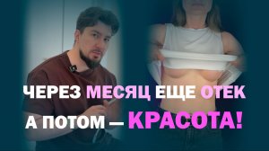 Небольшая асимметрия до операции: как выглядит грудь после увеличения