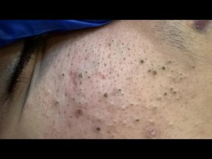 DEEP PORES GONE (Super Slowed) - Clay Mask & Steam | Facial Care Routine Edit