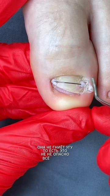 у ребенка врастает ноготь часть 5 из 6