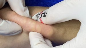 Выдавливание прыщей. «слабонервным не смотреть»