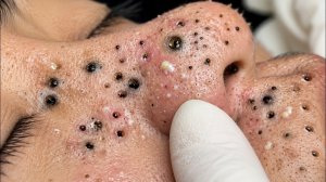 Выдавливание прыщей. Отличное качеств НОВОЕ