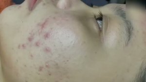 #755 Удаление акне. Экстракция комедонов. Подкожные прыщи. Чистка от черных точек