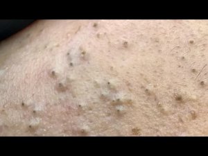 Глубокое очищение: чёрные точки, белые угри, прыщи | Результаты корейского ухода
