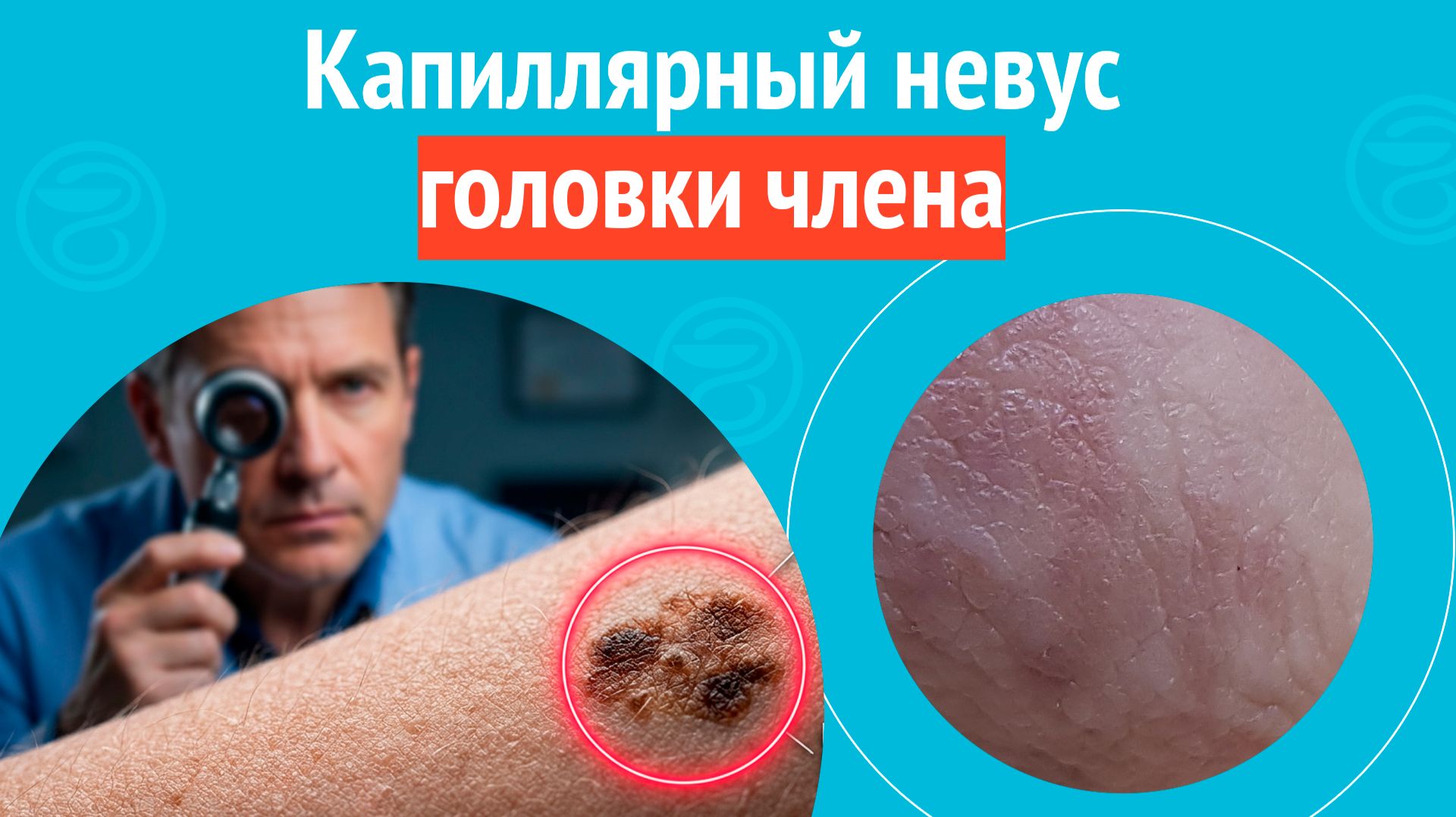 ↪  Капиллярный невус головки члена. Клинический случай №1629