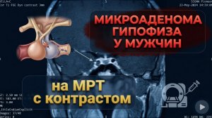 МИКРОАДЕНОМА гипофиза У МУЖЧИН на РАСШИФРОВКЕ (второе мнение) МРТ гипофиза с КОНТРАСТИРОВАНИЕМ