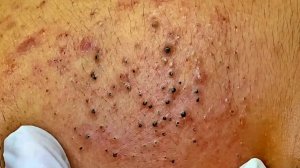 Удаление чёрных точек с Sac Dep Spa