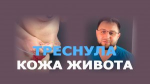 Абдоминопластика с ушиванием диастаза: результат через 4 месяца