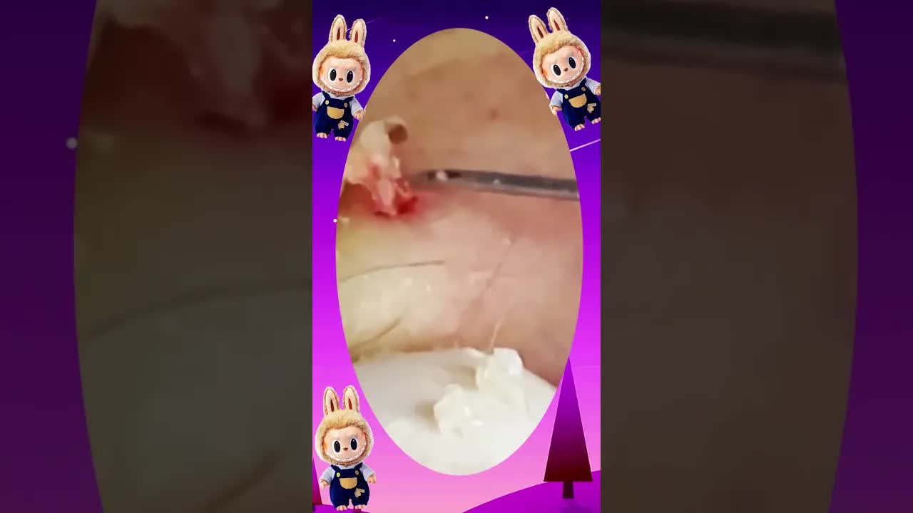 Satisfying Self-cleaning Of Blackheads Acne Treatment Pimple Pop