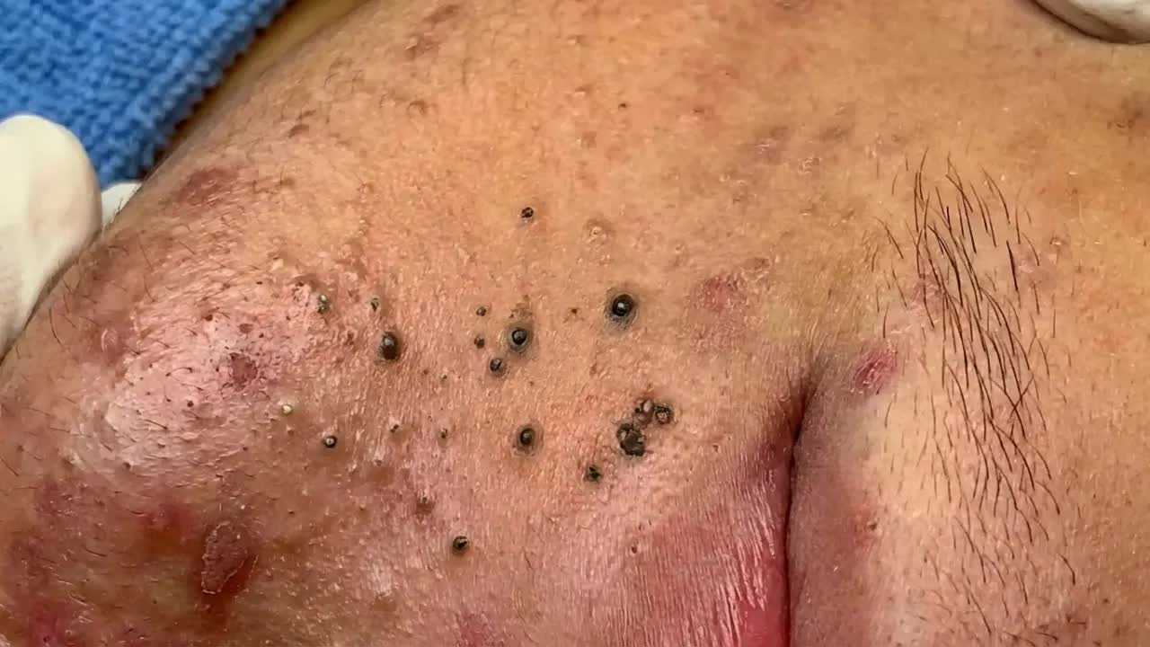 Удаление черных точек с Sac Dep Spa