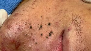Удаление черных точек с Sac Dep Spa