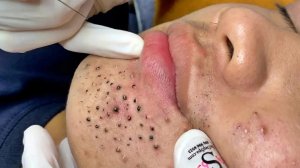 Удаление черных точек в Sac Dep Spa