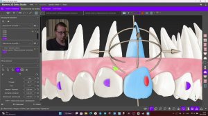Моделирование элайнеров в Maestro 3D | Ротация, скученность