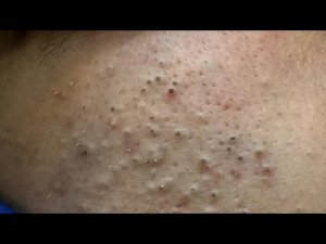 ASMR | Удаление чёрных точек | Глубокое очищение пор и уход за лицом