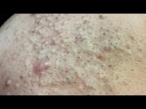 Топ-6 способов удаления черных точек