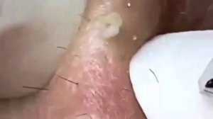 Extreme Blackhead Removal Satisfying Relaxing #1166