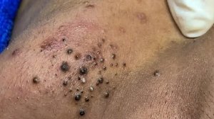 Удаление черных точек в Sac Dep Spa