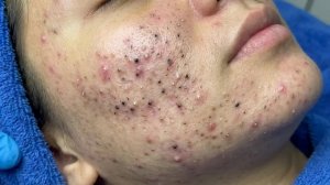 Удаление черных точек в Today Spa