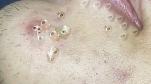 Экстремальное удаление черных точек: сатисфакция и релакс
