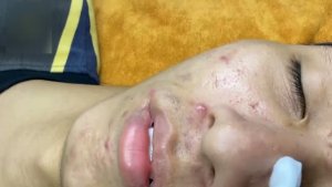 Удаление прыщей и чёрных точек – гигиенично и безопасно