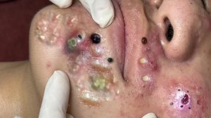 Extreme Blackhead Removal Satisfying Relaxing #1164