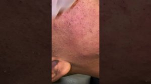 SO SATISFYING 😍 #skincare #blackheadremoval #deepporecleansing