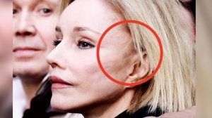 Жертва пластики или шрамы сойдут? Обсуждаем что произошло с лицом Марины Зудиной