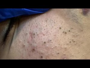 Глубокое очищение пор и удаление чёрных точек | ASMR — приятное выдавливание прыщей
