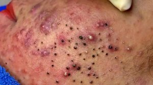 Удаление черных точек в Sac Dep Spa