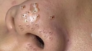 Экстремальное удаление черных точек: удовлетворение и релакс