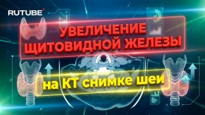 ДИФФУЗНЫЕ ИЗМЕНЕНИЯ щитовидной железы при ее УВЕЛИЧЕНИИ на РАСШИФРОВКЕ КТ мягких ткани шеи